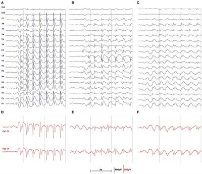 Absence Seizure Detection Algorithm for Portable EEG Devices